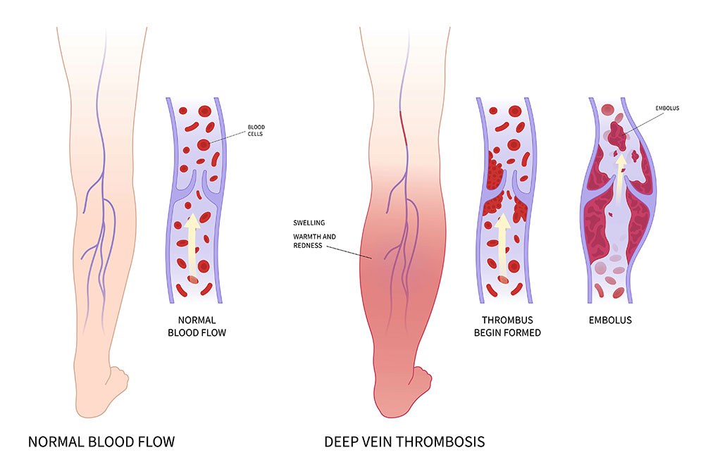 Beinvenenthrombose, Illustration